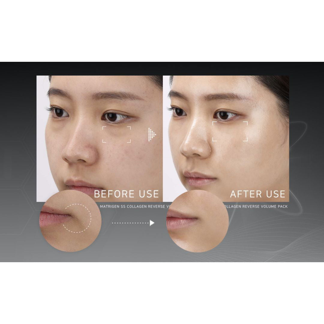 Matrigen SS Collagen Reverse Volume Pack + 1 Spatula - Miessential