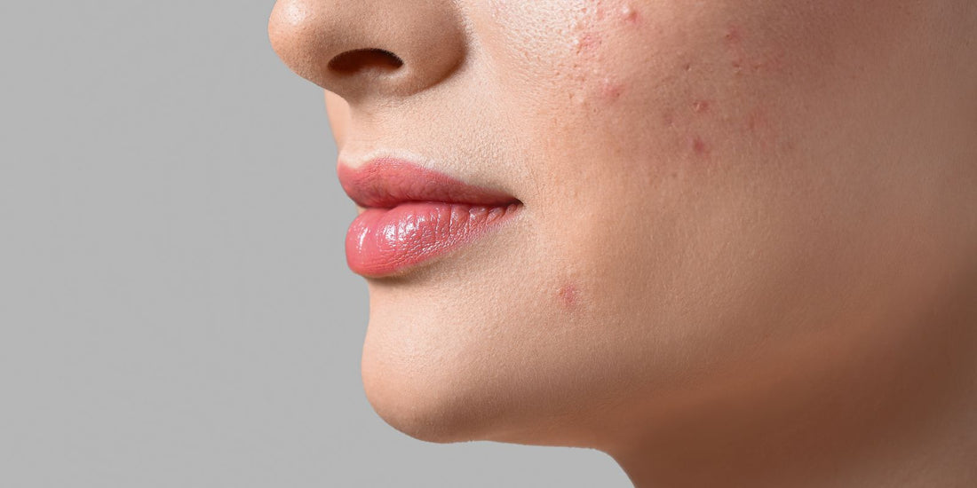 Clearing the Way: A Comprehensive Guide to Effective Acne Skincare