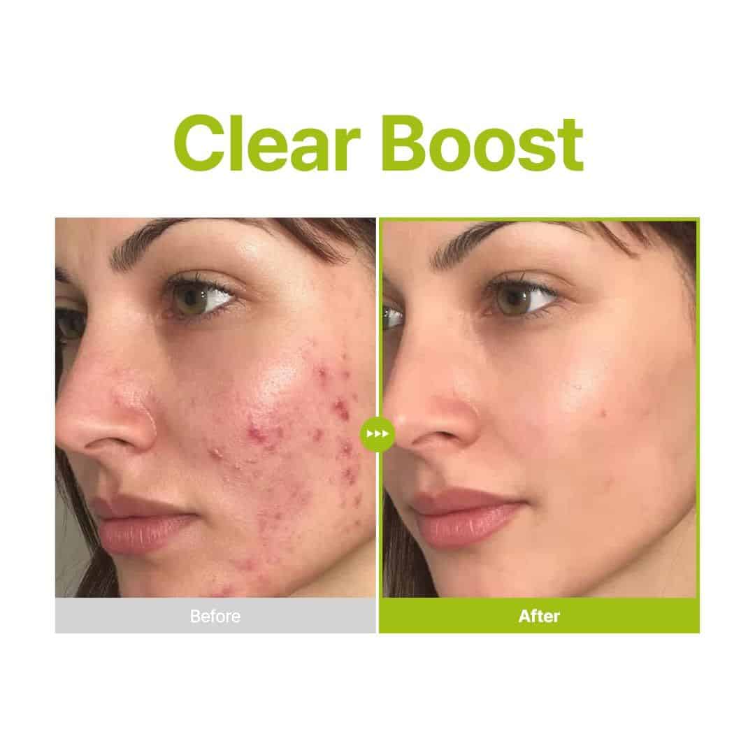 Purito Azelaic Acid 10 Kojic Tea Tree Serum